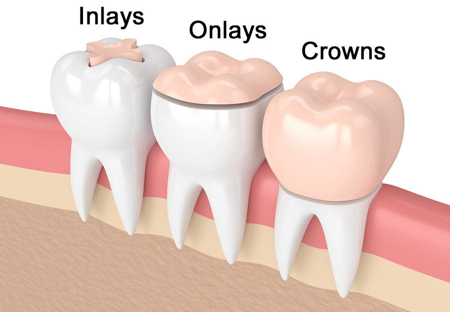 Balota Family Dentistry | Inlays & Onlays